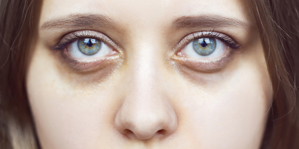 Nieuwe trend: donkere kringen onder je ogen